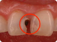 前歯に大きな虫歯があります