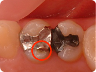 銀歯の境目に小さな虫歯ができています