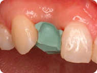両隣の歯を傷つけないために、接着性のあるレジンで歯を整形します